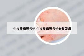 牛皮肤癣天气热 牛皮肤癣天气热会复发吗