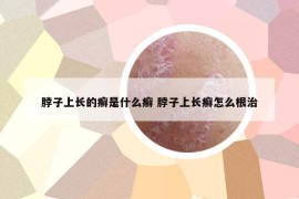 脖子上长的癣是什么癣 脖子上长癣怎么根治