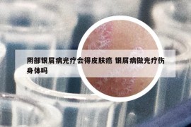 阴部银屑病光疗会得皮肤癌 银屑病做光疗伤身体吗