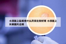 小孩腿上起癣用什么药膏比较好用 小孩腿上长癣图片还痒