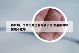 银屑病一个大斑旁边有好多小斑 银屑病斑块变成小疙瘩