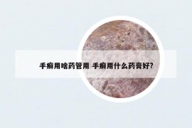 手癣用啥药管用 手癣用什么药膏好?