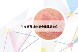 牛皮癣可以吃复合维生素b吗