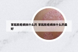 掌跖脓疱病抹什么药 掌跖脓疱病抹什么药最好