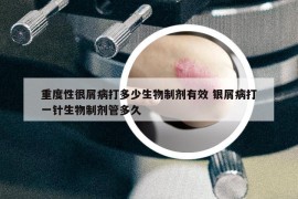 重度性很屑病打多少生物制剂有效 银屑病打一针生物制剂管多久