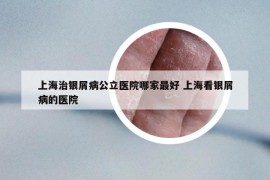 上海治银屑病公立医院哪家最好 上海看银屑病的医院