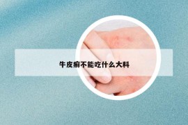 牛皮癣不能吃什么大料