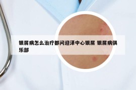 银屑病怎么治疗都问迎泽中心银屑 银屑病俱乐部