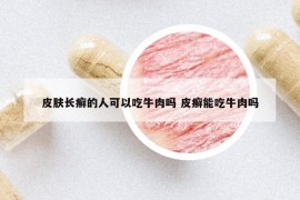 皮肤长癣的人可以吃牛肉吗 皮癣能吃牛肉吗