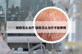 腿藓怎么治疗 腿藓怎么治疗才能断根