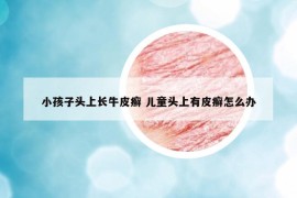 小孩子头上长牛皮癣 儿童头上有皮癣怎么办