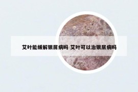 艾叶能缓解银屑病吗 艾叶可以治银屑病吗