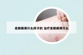 皮肤癣用什么样子的 治疗皮肤癣用什么