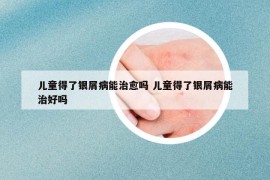 儿童得了银屑病能治愈吗 儿童得了银屑病能治好吗