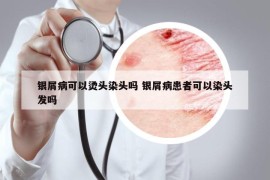 银屑病可以烫头染头吗 银屑病患者可以染头发吗