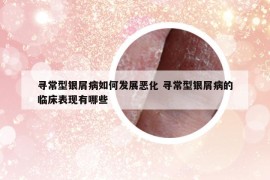 寻常型银屑病如何发展恶化 寻常型银屑病的临床表现有哪些