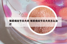 银屑病关节炎大夫 银屑病关节炎大夫怎么治疗