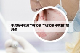 牛皮癣可以用二硫化硒 二硫化硒可以治疗银屑病