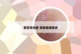 掌哲浓泡病 掌脓疱病症状