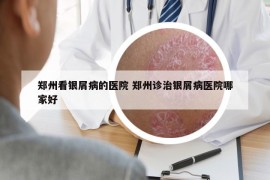 郑州看银屑病的医院 郑州诊治银屑病医院哪家好