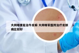 大同哪里能治牛皮癣 大同哪家医院治疗皮肤病比较好