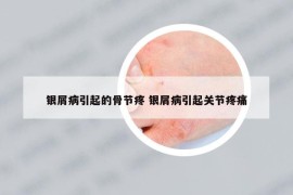 银屑病引起的骨节疼 银屑病引起关节疼痛