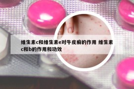 维生素c和维生素e对牛皮癣的作用 维生素c和b的作用和功效