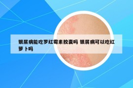 银屑病能吃罗红霉素胶囊吗 银屑病可以吃红萝卜吗