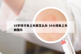 10岁孩子身上长癣怎么办 10小孩身上长癣图片