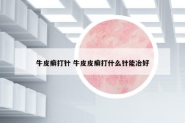 牛皮癣打针 牛皮皮癣打什么针能冶好