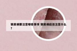 银屑病要注意哪些事项 银屑病应该注意什么?