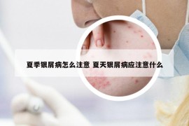 夏季银屑病怎么注意 夏天银屑病应注意什么