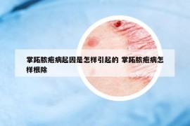 掌跖脓疱病起因是怎样引起的 掌跖脓疱病怎样根除