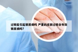 过敏能引起银屑病吗 严重的皮肤过敏会导致银屑病吗?