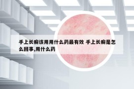 手上长癣该用用什么药最有效 手上长癣是怎么回事,用什么药