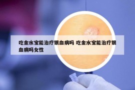 吃金水宝能治疗银血病吗 吃金水宝能治疗银血病吗女性