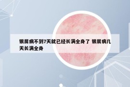 银屑病不到7天就已经长满全身了 银屑病几天长满全身