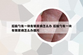 后脑勺有一块有银屑病怎么办 后脑勺有一块有银屑病怎么办图片