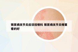 银屑病关节炎应该挂哪科 银屑病关节炎哪里看的好