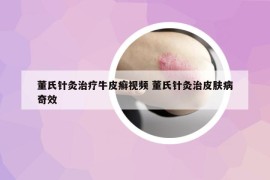 董氏针灸治疗牛皮癣视频 董氏针灸治皮肤病奇效