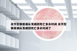 关节型银屑病从发病到死亡多长时间 关节型银屑病从发病到死亡多长时间了