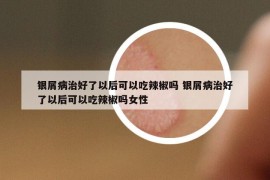 银屑病治好了以后可以吃辣椒吗 银屑病治好了以后可以吃辣椒吗女性