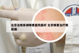 北京治银屑病哪里医院最好 北京哪里治疗银屑病