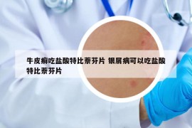 牛皮癣吃盐酸特比萘芬片 银屑病可以吃盐酸特比萘芬片