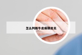 怎么判断牛皮癣跟皮炎