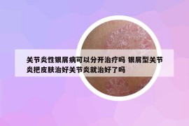 关节炎性银屑病可以分开治疗吗 银屑型关节炎把皮肤治好关节炎就治好了吗