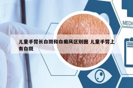 儿童手臂长白斑和白癜风区别图 儿童手臂上有白斑