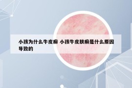 小孩为什么牛皮癣 小孩牛皮肤癣是什么原因导致的