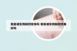 银屑病生物制剂管用吗 银屑病生物制剂效果好吗