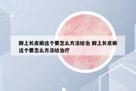 脚上长皮癣这个要怎么方法给治 脚上长皮癣这个要怎么方法给治疗